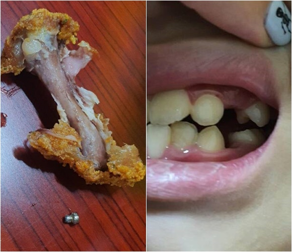 초등학교 5학년 아이가 치킨을 먹다가 나온 나사가 잇몸에 박혀 생니 두개를 뽑는 일이 발생했다. /사진=연합뉴스