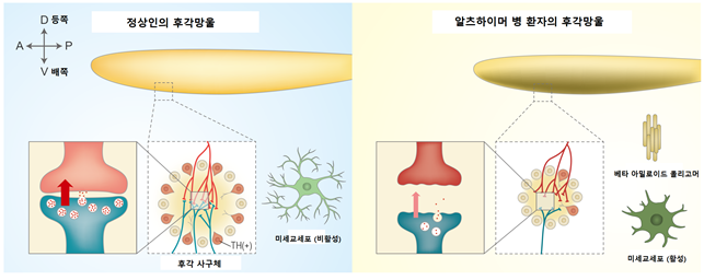 알츠하이머 환자 냄새 못 맡는 이유 밝혀냈다