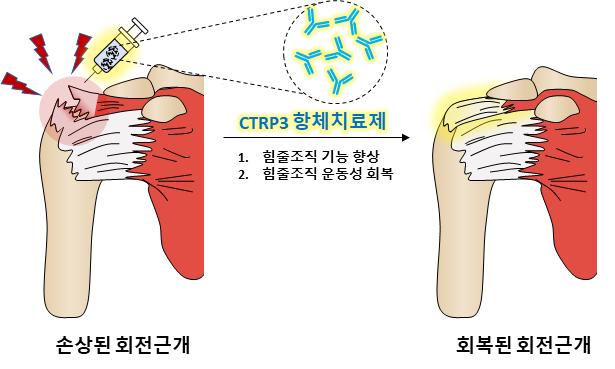 고질적 어깨 통증 '회전근개질환', 약물 치료법 세계 최초 발견