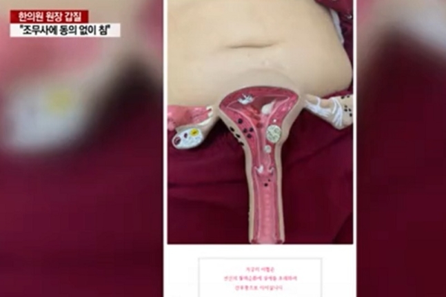 한의사 원장이 간호조무사의 배에 자궁 모형을 올려놓고 사진을 찍어 인터넷에 올렸다. /사진=YTN 방송 캡처