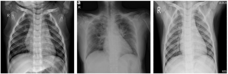 (왼쪽부터) 정상인, 코로나19 환자, 바이러스성 폐렴 환자의 폐 X레이 사진(사진제공=MDPI).