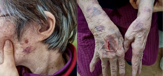 노인복지센터에서 폭행을 당한 80대 할머니의 멍과 상처. /사진=온라인 커뮤니티 '네이트판' 캡처