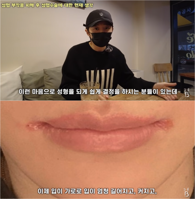 아이돌 출신 모델, 입꼬리 성형 부작용 고백…"엄청난 통증 겪어"