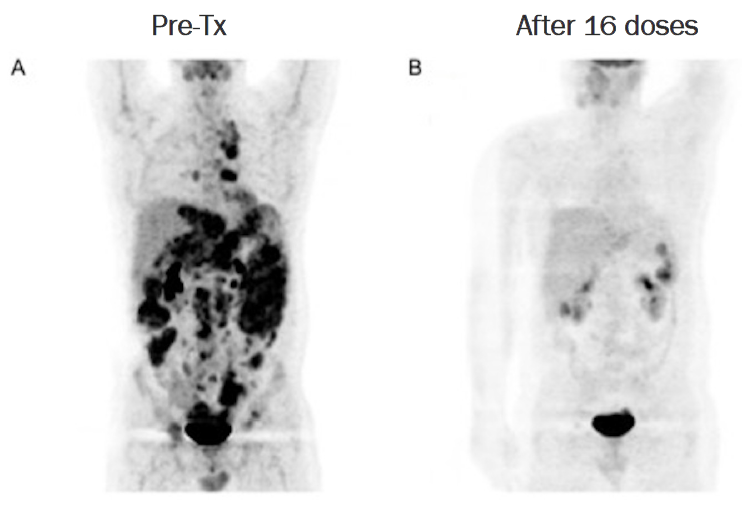 슈퍼NK(SNK01) 병용투여 전(A)과 후(B) 종양 소멸 비교 사진.