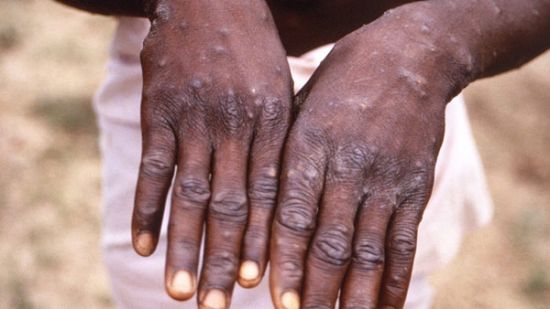 WHO "원숭이두창, 과민 반응 말라"…獨은 이미 백신 4만회 주문 완료