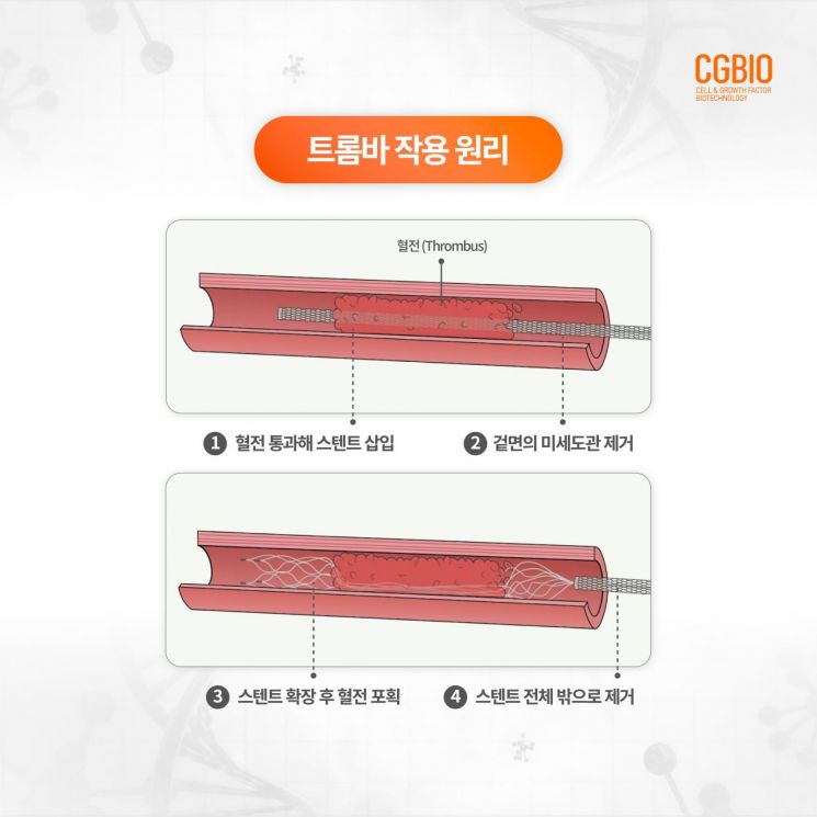 시지바이오, 뇌혈전제거용 스텐트 '트롬바' 허가…첫 국산화 성공