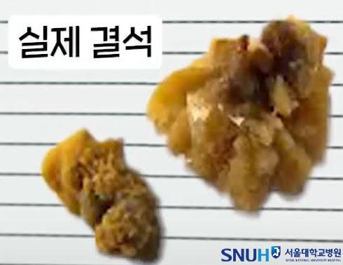 [콕!건강] '출산만큼 아프다?'… 요로결석, 어떻게 예방해야 할까