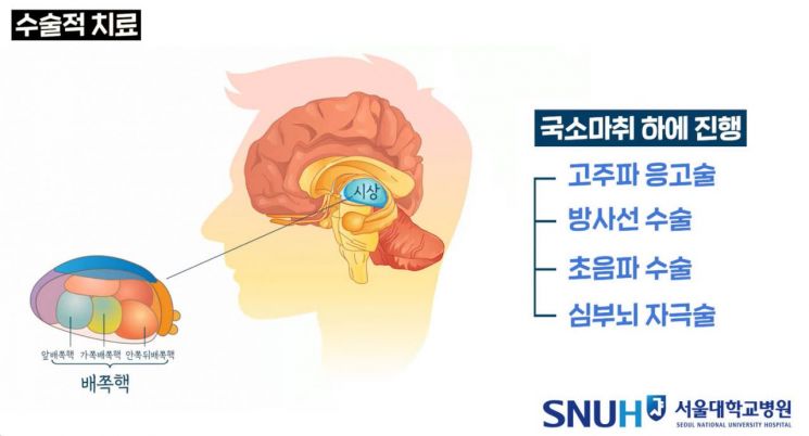 [콕!건강]젓가락질에도 손 '덜덜'…수전증 어떻게 치료하나요