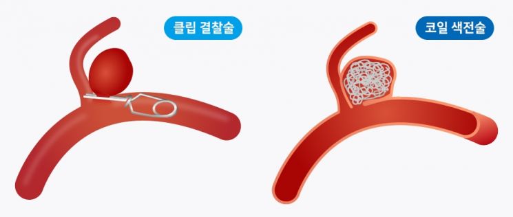 뇌동맥류의 대표적 수술적 치료인 클립 결찰술과 코일 색전술.[사진제공=강동경희대병원]