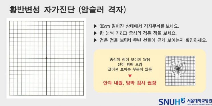 [콕!건강]실명까지 유발하는 황반변성…자가진단 '이렇게'
