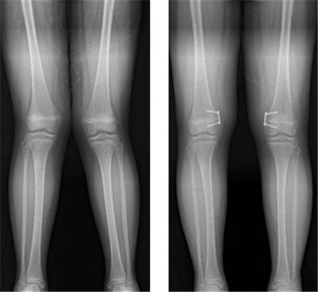 "소아 휜다리 수술, 재발 막으려면 교정속도·연령 고려해야"