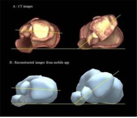 모바일 진단 애플리케이션을 통해 재건한 3차원 사진(하단부).
3차원 CT 사진(상단부)과 비교해 정확도 높은 영상을 구현한 것을 확인할 수 있다.[사진제공=분당서울대병원]