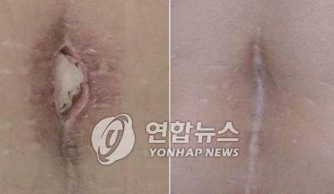 상처가 아물지 않았던 부위에 구더기를 넣어 치료하는 장면(왼쪽)과 구더기 치료 후 상처가 아문 모습. 사진=연합뉴스