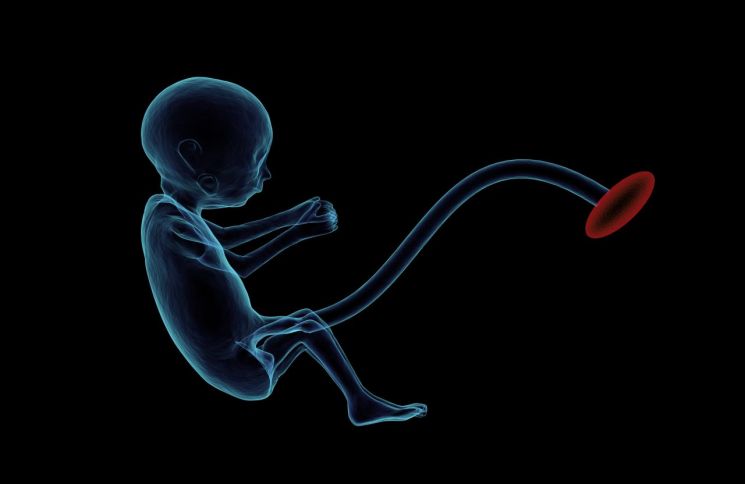 생후 3주 아기 배 속에서 태아 8명 발견 … 발생률 50만분의 1 ‘태아 속 태아’ 