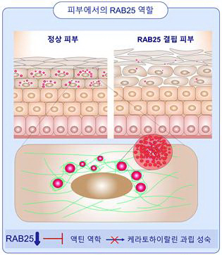 RAB25가 결핍되면 세포 운동성이 떨어져 케라토하이알린과립 성장이 저해되는 것으로 확인됐다. 이는 피부 보습 등에 부정적인 영향으로 이어졌다.[사진제공=연세의료원]