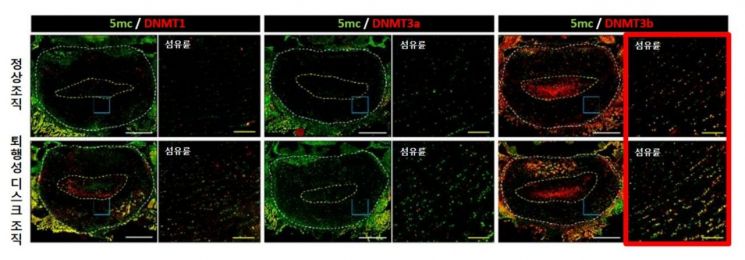 퇴행이 진행된 디스크의 DNA 메틸화에 DNMT3b 효소가 가장 크게 관여하는 것으로 나타났다.[사진=자생한방병원 제공]