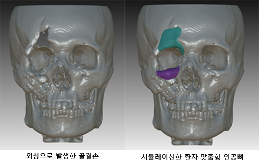 [콕!건강]함몰된 안면부, 3D프린터로 '인공 뼈' 만든다고? 