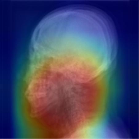 두경부 엑스레이 영상을 활용한 수면무호흡증 진단 예시. 딥러닝 알고리즘이 수면무호흡증 여부를 분류하는 이미지에서 특이점의 위치(붉은색)를 확인할 수 있다.[사진제공=분당서울대병원]