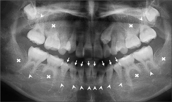 조혈모세포이식을 받은 환아의 치아 엑스레이 검사 사진. X표는 치아 형성 부전으로 영구치 결손, 화살표는 왜소치, 치아 뿌리 부분의 꺽쇠(^)는 치근 형성 이상을 표시했다.[사진제공=서울성모병원]