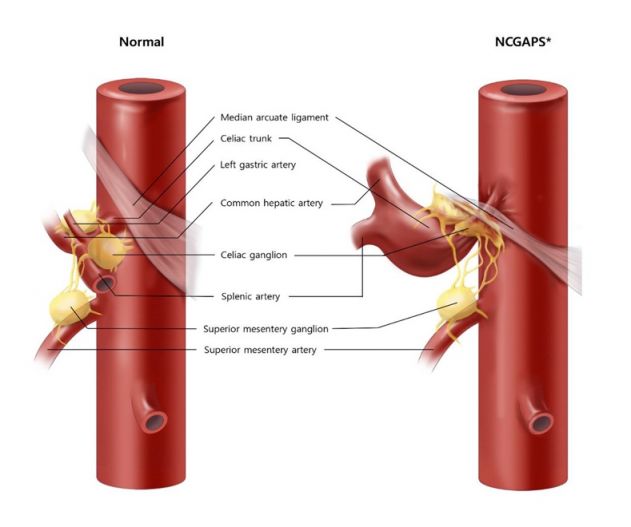 "원인 모를 반복·극심한 복통 일으킬 때 '호두까기복통' 의심해야"
