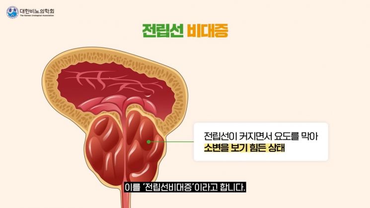 전립선 비대증 설명 그림 [이미지출처=대한비뇨의학회 유튜브]