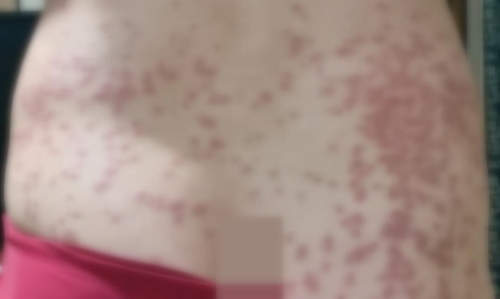 모텔 침대 들춰보니 벌레 '바글바글'…사장 "공사일 하는 손님이 옮겨왔을 수도"