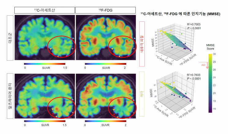 알츠하이머 환자의 PET 영상 및 11C-아세트산 및 18F-FDG 흡수 변화에 따른 인지기능의 상관관계. 그림출처=IBS 제공