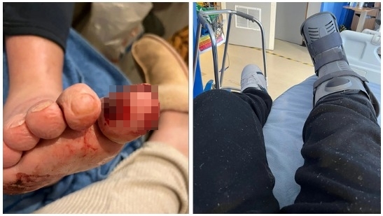 린지는 반려견 때문에 발가락을 다쳤지만, 더 큰 병을 찾아내 큰 화를 면했다 [사진출처=미국 뉴욕포스트]