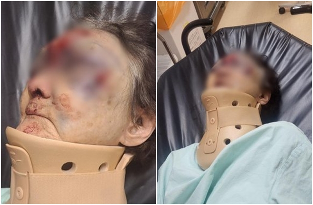 멍투성이로 발견된 치매 할머니 '잔혹폭행 논란'…CCTV 결과 "낙상"