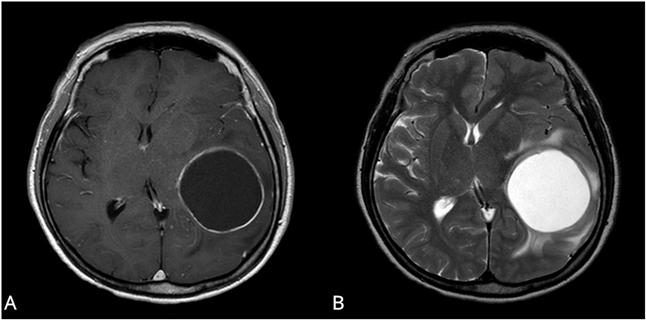교모세포종 환자의 MRI 사진. 체액 성분이 대부분인 낭종이 있는 낭성군 환자(왼쪽, A)가 비낭성군 환자에 비해 유의하게 생존기간이 길었다.[사진제공=서울성모병원]
