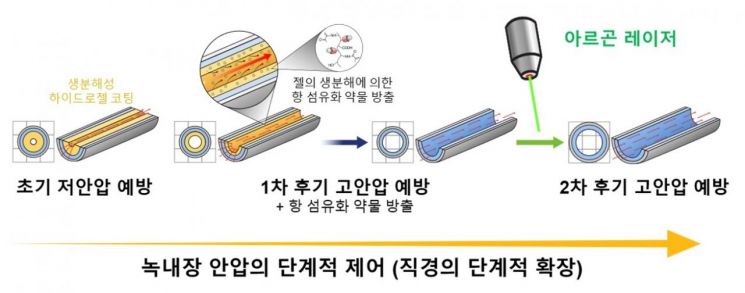 연세대 연구팀이 개발한 방수 튜브의 녹내장 병기에 따른 안압 조절 원리.[사진제공=연세의료원]