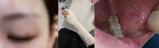 학생에게 폭행을 당한 서울 양천구 소재 초등학교 교사 A씨의 피해 모습. [사진제공=서울교사노조]