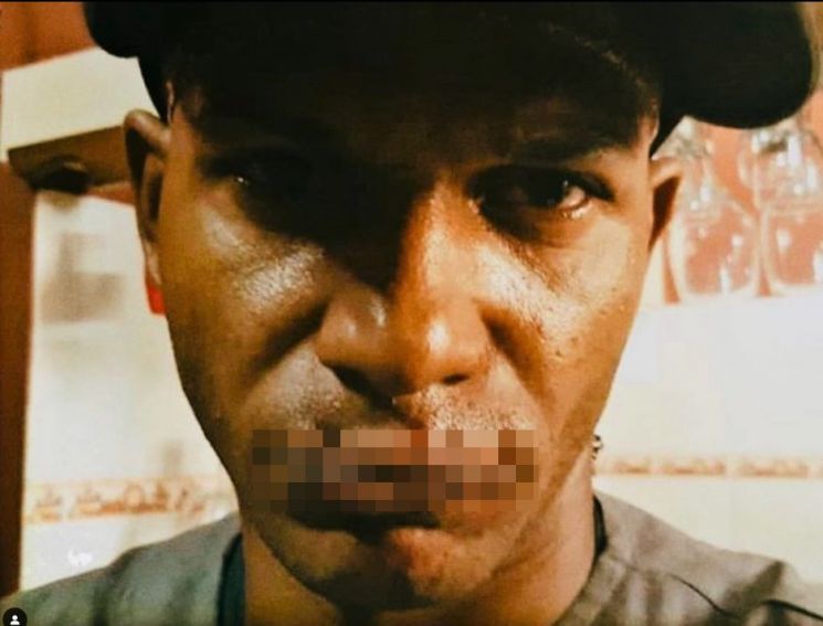 쿠바에서 반체제 활동을 벌였다가 실형을 받은 한 래퍼가 수감 생활 중 받은 학대에 대한 저항의 뜻으로 자기 위·아래 입술을 꿰매 붙이는 사건이 발생했다. [사진출처=인스타그램 'maykelosorbo']