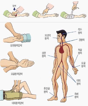출혈 부위를 심장보다 높이 하고 지혈…응급처치 이렇게 하세요