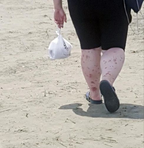 행사장에서 창궐한 벌레 떼에 물린 한 참가자의 다리. [사진출처=연합뉴스]