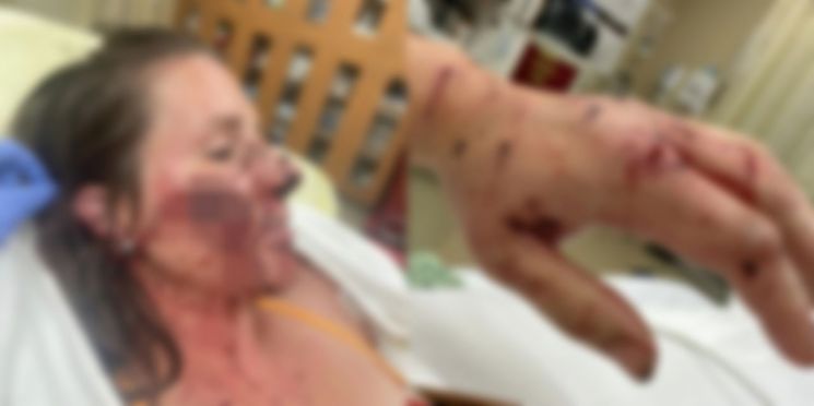 이후 로이스는 자신의 페이스북을 통해 사고 당시 상황과 수달의 공격으로 얼굴·팔다리 등이 피투성이가 된 근황을 알렸다. [사진출처=젠 로이스 페이스북]