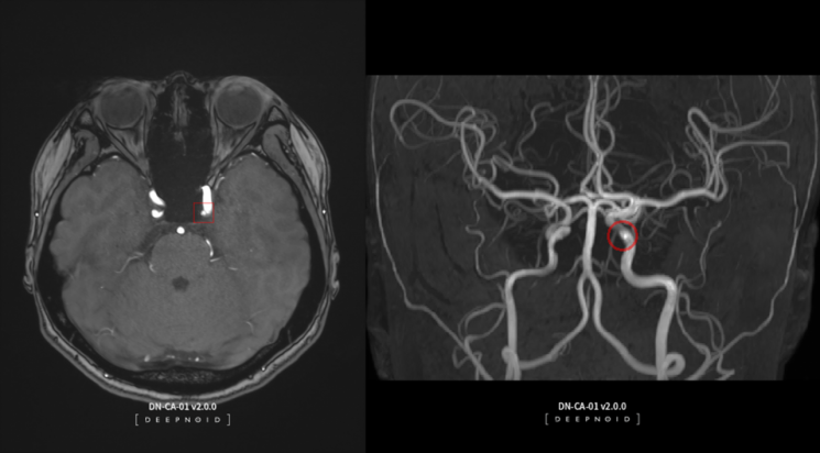 의료용 AI 솔루션인 딥뉴로. 딥뉴로를 활용하면 뇌동맥류 의심 부위를 확인할 수 있다. 사진제공=딥노이드