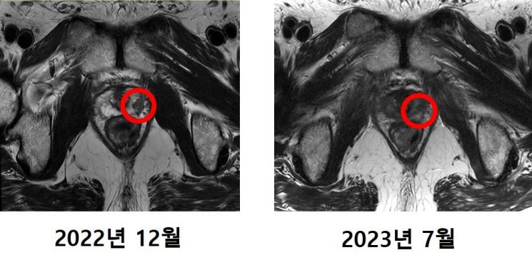 최씨의 MRI 촬영 사진. 기존에 발견됐던 암 조직(왼쪽 사진 표시)이 치료 후에는 발견되지 않았다.