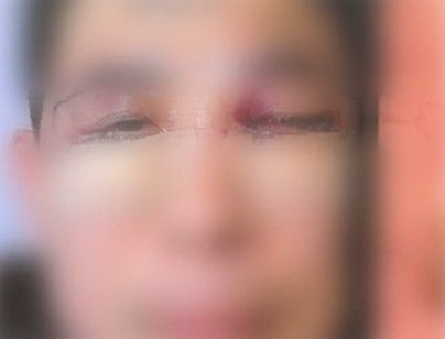 "성형 후 눈이 안 보여"…강남 병원에선 "흔한 증상"