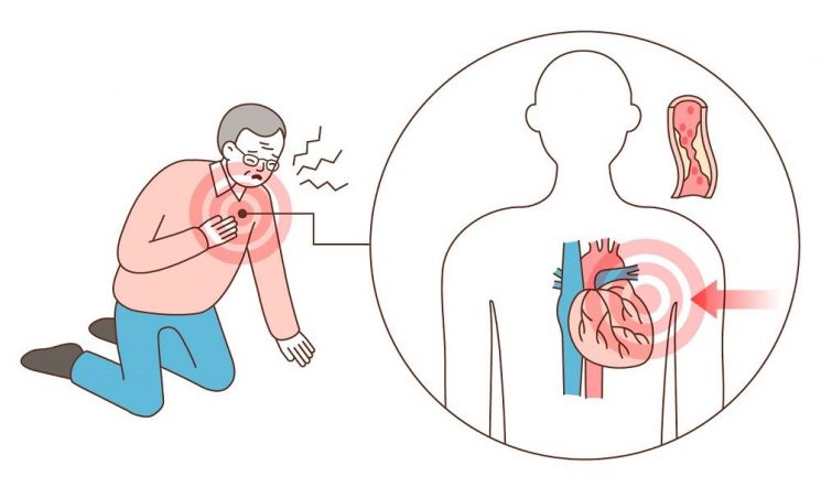 심근경색 이미지 [사진제공=강남베드로병원]