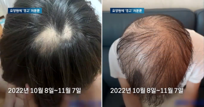 김 씨는 복무 18개월 차였던 지난해 10월, 머리카락이 빠지기 시작하더니 한 달 만에 거의 남지 않게 됐다. 머리카락뿐만 아니라 코털 등 다른 부위 체모도 빠져서 숨을 쉬는 데도 지장이 생길 정도가 됐다. [사진출처=JTBC]