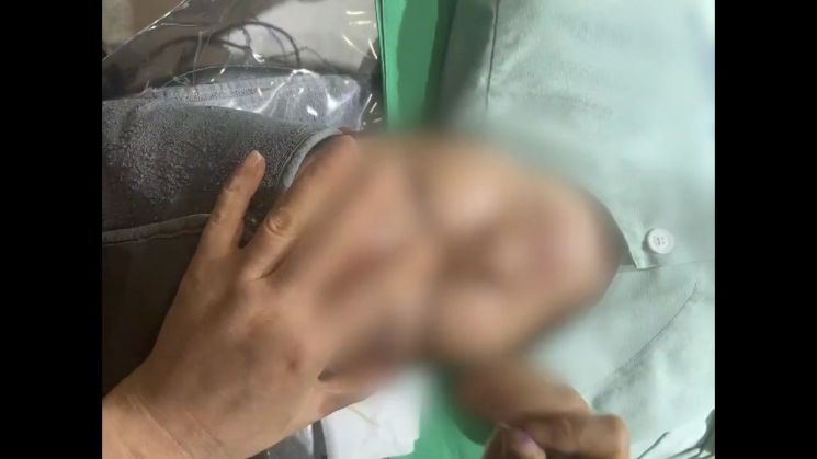 간호조무사 B씨의 불법 성형수술 장면. [사진 제공=부산경찰청]