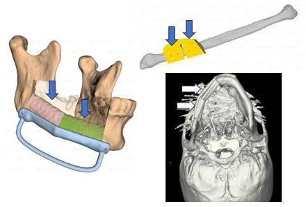 디지털 프로그램과 3D 프린팅 기술을 이용해 광범위한 구강암 수술 후 턱뼈를 정교하게 재건한 모습. [사진제공=서울대병원]
