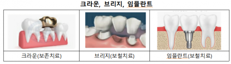 "임플란트 보험금, 자가발치하면 못 받아"…꼭 알아야 할 보험 필수 상식