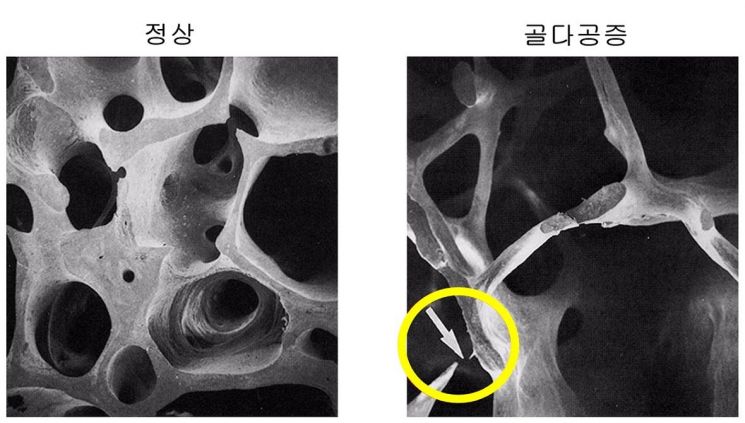 뼈단면 비교사진(정상환자·골다공증환자).