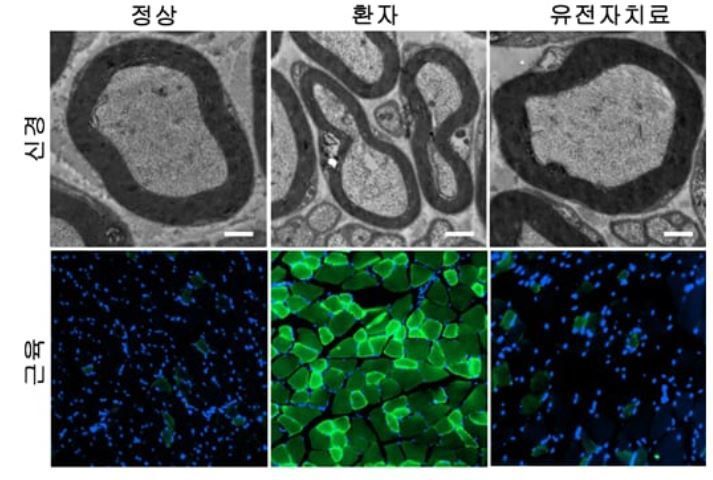 연구진은 샤르코 마리 투스병의 발병 원인을 세계 최초로 밝히고, 맞춤형 유전자 치료법도 제안했다. [이미지출처=서울대]