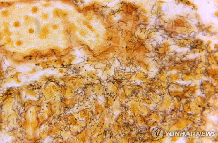 미국 질병통제예방센터(CDC)가 공개한 매독에 감염된 인체 조직의 현미경 사진 [사진출처=연합뉴스]