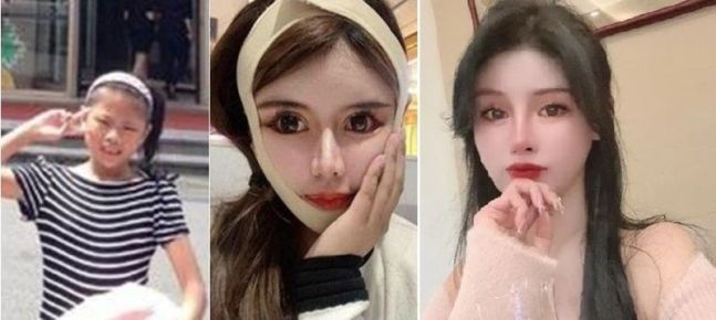 '100번 이상 성형' 19살 중국 여성 "더 안한다"…극심한 부작용은 이제부터