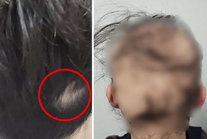 "석달새 다 빠지고 여친도 떠나" 급성탈모 공개한 남성, 원인은 이것