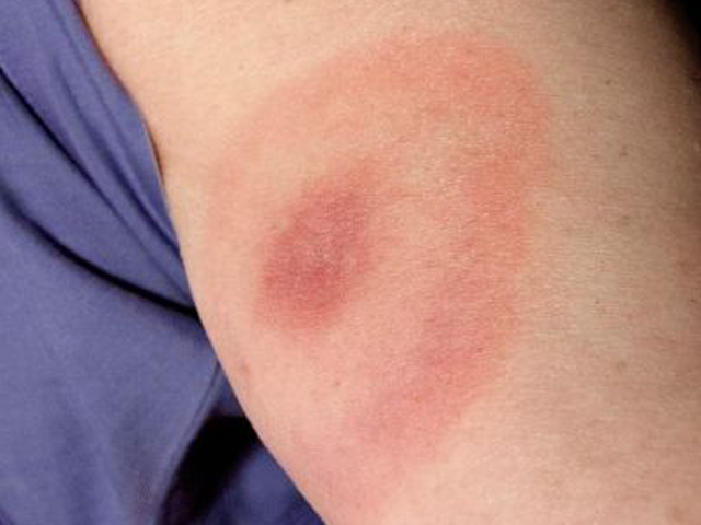 한 라임병 환자의 팔에 붉은 반점과 이를 둘러싼 옅은 고리가 나타나있다. 사진=미국 질병통제예방센터(CDC)